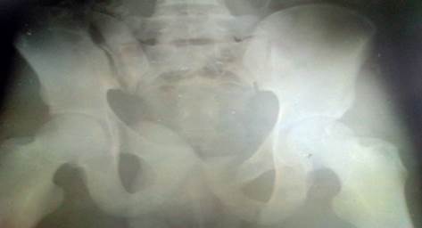 Radiograf&iacute;a de pelvis &oacute;sea en proyecci&oacute;n anteroposterior donde se observa fractura de pelvis tipo C seg&uacute;n la clasificaci&oacute;n de Marvin Tile