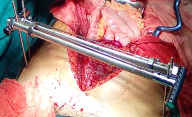 Transoperatorio donde se observa laparotom&iacute;a y fijador externo colocado