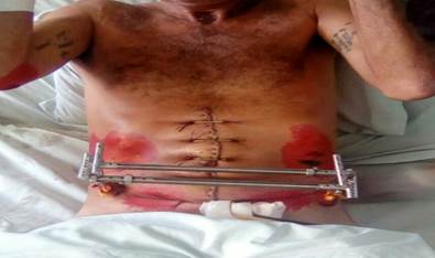 Posoperatorio a los siete d&iacute;as donde se observa el paciente sentado en la cama con la cistotom&iacute;a