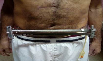 Posoperatorio a los dos meses dondese observa el paciente en bipedestaci&oacute;n a&uacute;n con la cistotom&iacute;a