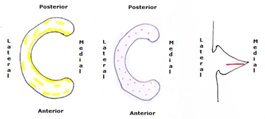 De izquierda a derecha, lesiones degenerativas tipo I (meniscitis), tipo II (meniscocalcinosis), desgarro horizontal tipo III