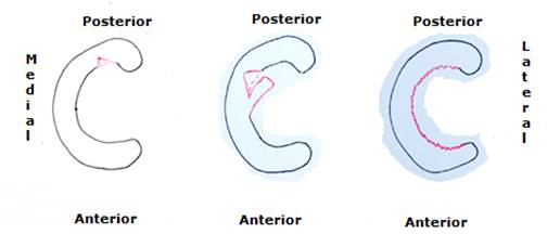 De izquierda a derecha, desgarro tipo IVa, tipo IVb y tipo V