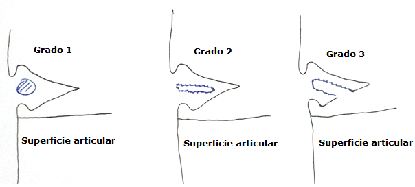 Clasificaci&oacute;n basada en la imagen de resonancia magn&eacute;tica seg&uacute;n Raunest J, et al. (24)