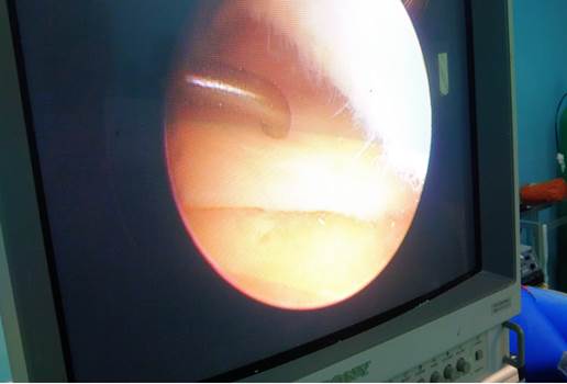 Consistencia blanda del menisco medial (tipo 1) al ser palpado con el explorador artrosc&oacute;pico. Obs&eacute;rvese en la parte superior derecha el c&oacute;ndilo femoral medial con caracter&iacute;sticas de tipo degenerativa