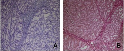 :Proliferaci&oacute;n compactada de gl&aacute;ndulas de Brunner las cuales se encontraban compartimentaizadas por tabiques conectivos de col&aacute;geno. Coloraci&oacute;n con H/E. :Coloraci&oacute;n con t&eacute;cnica de Van Gieson para fibras col&aacute;genas de los tabiques fibrosos.