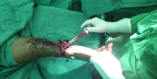 Fractura abierta a nivel de la mu&ntilde;eca derecha con exposici&oacute;n del c&uacute;bito cerca de dos tercios de su extensi&oacute;n Obs&eacute;rvese la gran contaminaci&oacute;n del c&uacute;bito y la herida