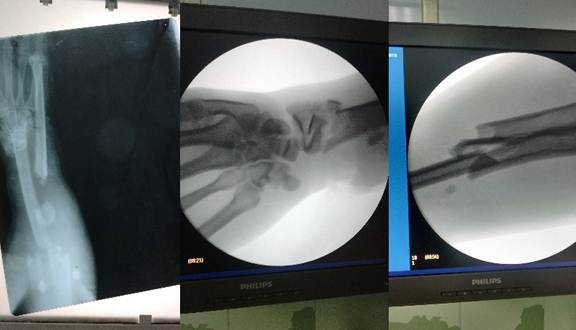 Evidencia radiogr&aacute;fica de fractura segmentaria del radio derecho (derecha) fractura conminuta del radio distal (centro) y fractura proximal del radio (izquierda) Obs&eacute;rvese el desplazamiento marcado del c&uacute;bito
