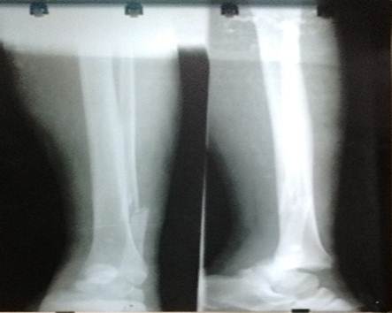 Obs&eacute;rvese luxaci&oacute;n de la articulaci&oacute;n tibio-astragalina izquierda y fractura del peron&eacute;