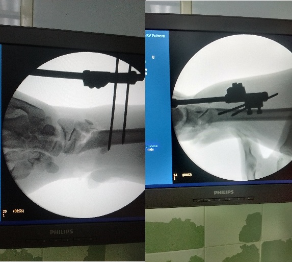 Fijaci&oacute;n externa de la mu&ntilde;eca derecha. (Imagen propia de los autores)