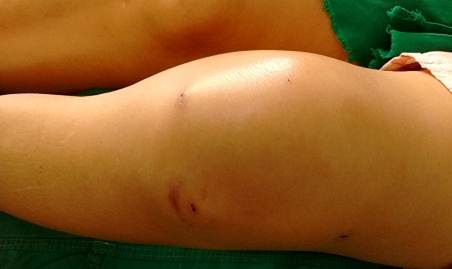 Paciente con artritis s&eacute;ptica de la rodilla despu&eacute;s de un procedimiento artrosc&oacute;pico, obs&eacute;rvese la distenci&oacute;n articular