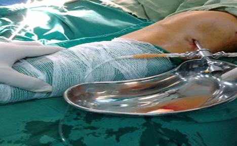 Drenaje de la articulaci&oacute;n mediante la c&aacute;nula artrosc&oacute;pica Obs&eacute;rvese en la bandeja el l&iacute;quido articular turbio hem&aacute;tico con grumos y pus