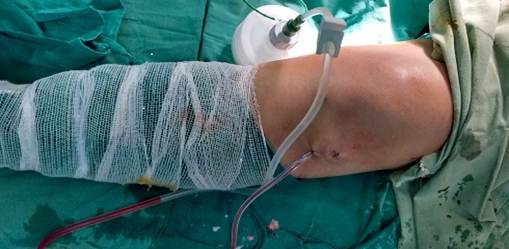 Despu&eacute;s de terminada la cirug&iacute;a por v&iacute;a artrosc&oacute;pica se coloca drenaje aspirativo. obs&eacute;rvese adem&aacute;s algunos grumos extra&iacute;dos en la parte lateral de la rodilla 