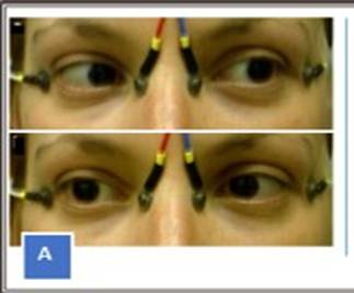 Electrooculograf&iacute;a. Colocaci&oacute;n de electrodos para las derivaciones horizontales de cada ojo seg&uacute;n Constable PA et al. (3)