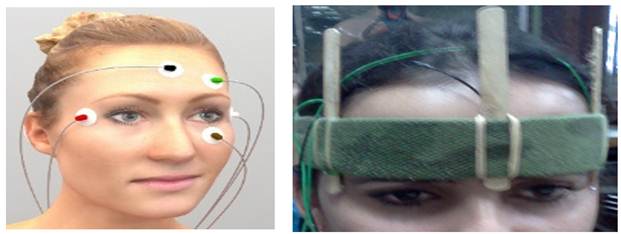 Colocaci&oacute;n de electrodos para registro de ENG (Izquierda Distribuci&oacute;n de electrodos con dos canales: horizontal y vertical. Derecha: Colocaci&oacute;n de los electrodos en cinta de ajuste con gu&iacute;as de los electrodos que pueden ser desplazadas en sentido horizontal y vertical para el ajuste de la posici&oacute;n.