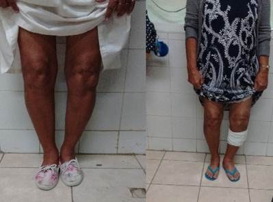 Desviaci&oacute;n angular en varo de la rodilla izquierda antes y despu&eacute;s de la cirug&iacute;a.