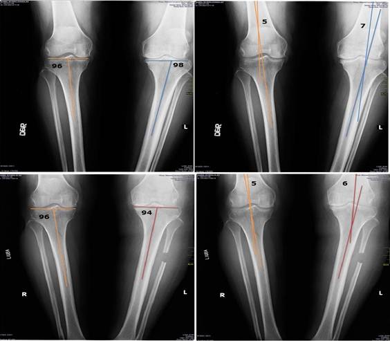 &Aacute;ngulos tibial y femorotibial antes y despu&eacute;s de la cirug&iacute;a.Arriba (antes de la operaci&oacute;n) &aacute;ngulo tibial antes rodilla derecha 96 grados, &aacute;ngulo femorotibial 5 grados en varo, rodilla izquierda &aacute;ngulo tibial 98 grados,rodilla izquierda 7 grados. Abajo despu&eacute;s de la operaci&oacute;n, &aacute;ngulo tibial de la rodilla derecha 96 grados, rodilla izquierda 94 grados, &aacute;ngulo femorotibial rodilla derecha 5 grados y rodilla izquierda 6 grados.