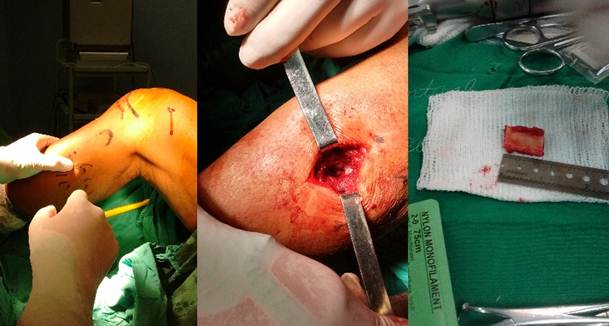 Intervenci&oacute;n quir&uacute;rgica combinada de artroscopia y ostectom&iacute;a proximal del peron&eacute; en un mismo tiempo quir&uacute;rgico y anest&eacute;sico.