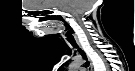 Estenosis traqueal a nivel de D2, marcado con flecha