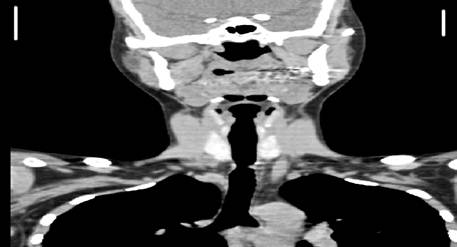 Estenosis traqueal a nivel de D2, marcado con flecha roja