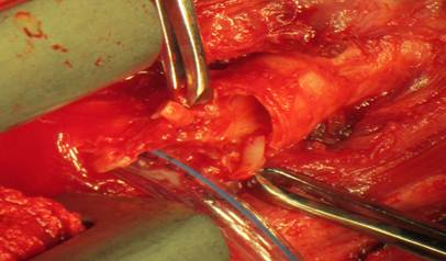 Resecci&oacute;n del segmento estenosado de la tr&aacute;quea