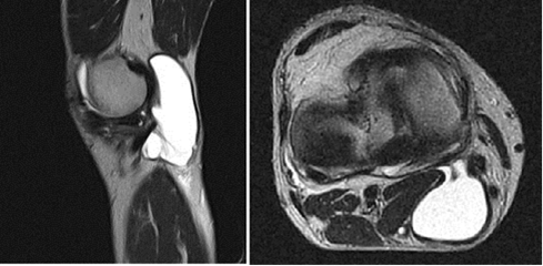 Quiste de Baker de la rodilla derecha Flecha azul: v&aacute;lvula entre la articulaci&oacute;n y el Quiste de Baker