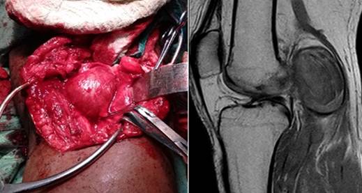 Paciente con aneurisma trombosado de la arteria popl&iacute;tea