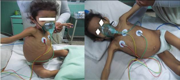 Preescolar transicional con aspecto de desnutrici&oacute;n cr&oacute;nica en l&iacute;nea marasm&aacute;tica, con gran distensi&oacute;n abdominal a expensas de hepatomegalia, durante ingreso en unidad de cuidados intensivos pedi&aacute;tricos.
