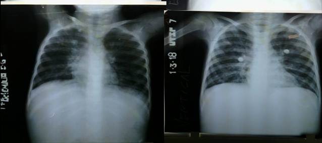 Rayos X de t&oacute;rax. Hilios prominentes, microatelectasias por impactaci&oacute;n mucosa, signos de atrapamiento a&eacute;reo, acentuaci&oacute;n de las densidades lineales de la trama broncovascular perif&eacute;rica.