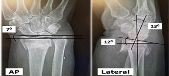 Radiograf&iacute;a simple de mu&ntilde;eca derecha. Vista AP: &aacute;ngulo de inclinaci&oacute;n radial inadmisible y alineaci&oacute;n de los estiloides radial y cubital. Vista lateral: Inversi&oacute;n del &aacute;ngulo de inclinaci&oacute;n volar.