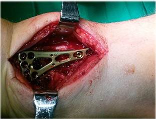 Adecuada colocaci&oacute;n del implante en cara volar del radio distal.