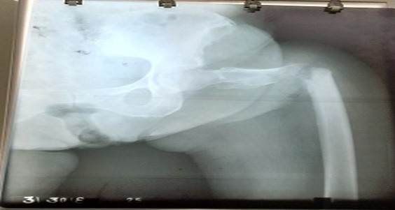 Paciente de 81 años de edad, femenina, que sufre fractura patológica en el área subtrocantérica, diagnosticada hace diez años de cáncer cervico-uterino, dolor previo en la zona antes de la fractura interpretado como una ciatalgia y trauma mínimo por un mecanismo de torsión frente a su cocina.