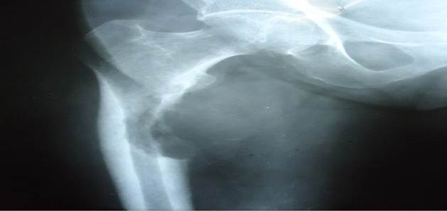 Imagen metastásica de carcinoma de pulmón en el fémur derecho con riesgo de fractura patológica, 11 puntos según la puntuación de Mirel H. 28