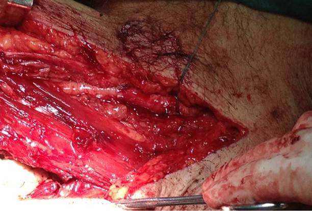 Control arterial proximal para evitar el sangramiento tras-operatorio durante la resección de la metástasis ósea.