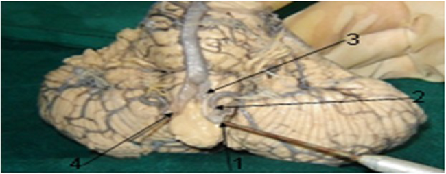 Arteria vertebral izquierda que se contin&uacute;a en la arteria cerebelar posteroinferior, emite un ramo a la uni&oacute;n v&eacute;rtebrobasilar. 1 arteria vertebral izquierda; 2 arteria cerebelar posteroinferior; 3 ramo a la uni&oacute;n v&eacute;rtebrobasilar; 4 A vertebral derecha.