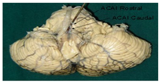 Arteria cerebelar anteroinferior izquierda doble.