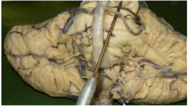 Arteria cerebelar superior izquierda doble.