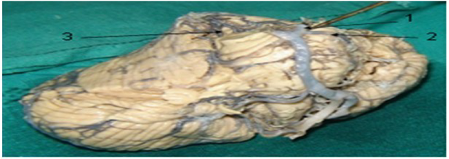 Arteria cerebelar superior con origen en la arteriacerebral posterior a nivel de la cara anterior del puente.1 arteria cerebral posterior; 2 arteria cerebelar superior; 3 surco protuberancial superior.