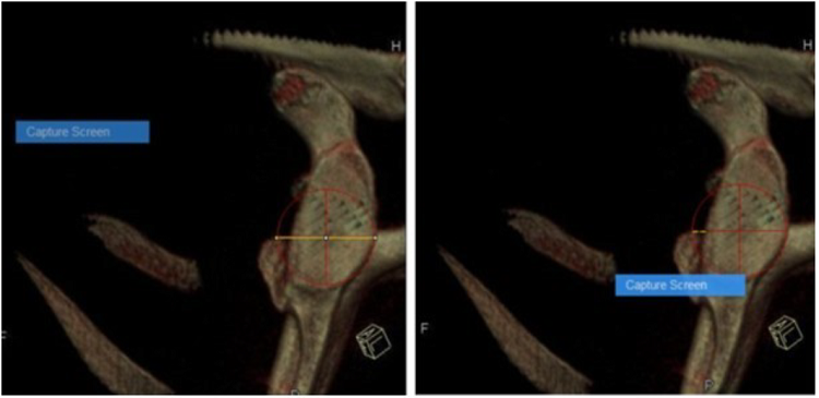 M&eacute;todo del di&aacute;metro. Porcentaje de p&eacute;rdida de fragmento &oacute;seo=(di&aacute;metro del defecto) 23/ (di&aacute;metro del c&iacute;rculo) 123 x 100 %. Resultado: 18 %. 