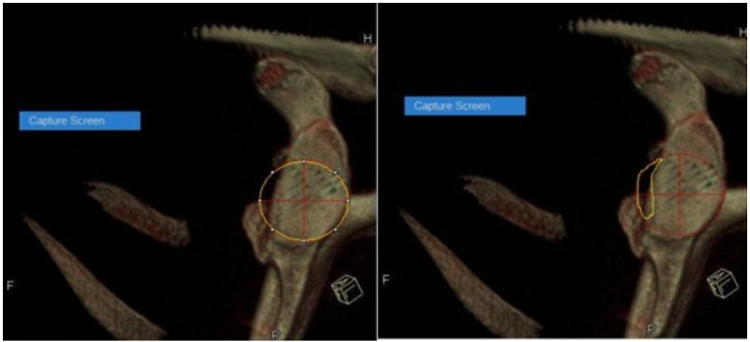 M&eacute;todo del &aacute;rea de superficie. Porcentaje de p&eacute;rdida del fragmento &oacute;seo= (defecto de la superficie) 2043/(superficie del c&iacute;rculo) 10753x 100 %. Resultado: 18 %.