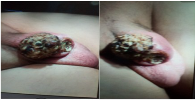 En la imagen se observa tumoraci&oacute;n del pene de tipo carcinoma escamosos que ocupa la totalidad del cuerpo del pene.