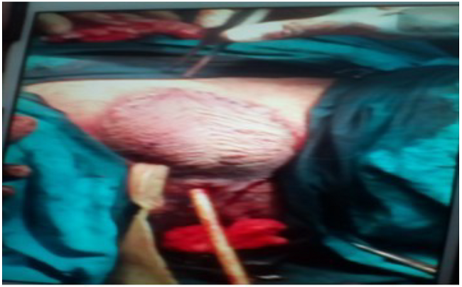 En la figura se observa la cirug&iacute;a realizada en la regi&oacute;n inguinal para toma de muestra de loa ganglios para biopsia, al igual que se realiz&oacute; ex&eacute;resis de una muestra del tumor del pene.