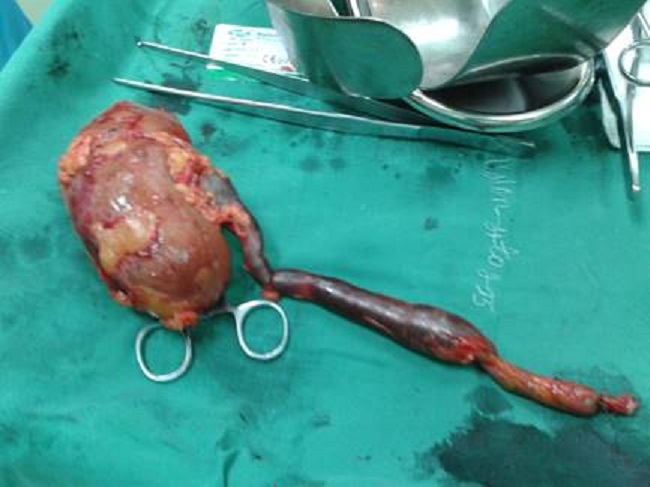 Tumor de cavidades renales que infiltra la totalidad del ur&eacute;ter con necrosis del mismo.