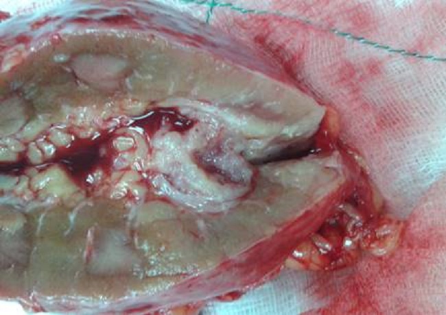 Presencia del tumor de cavidades renales que ocupa los tres grupos caliciales y la pelvis renal.