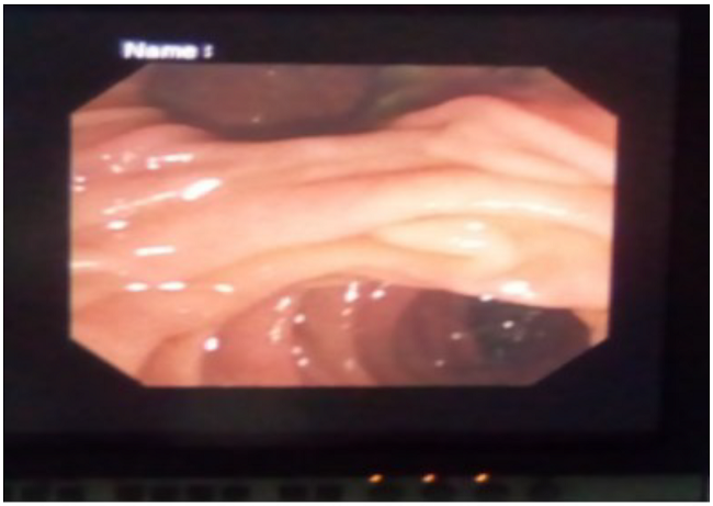 Segunda porci&oacute;n duodenal (luz inferior) con presencia de divert&iacute;culo yuxtapapilar (luz superior).