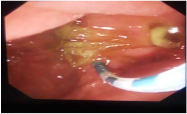 Canulaci&oacute;n de la papila duodenal a trav&eacute;s de un cat&eacute;ter con presencia de un divert&iacute;culo yuxtapapilar.