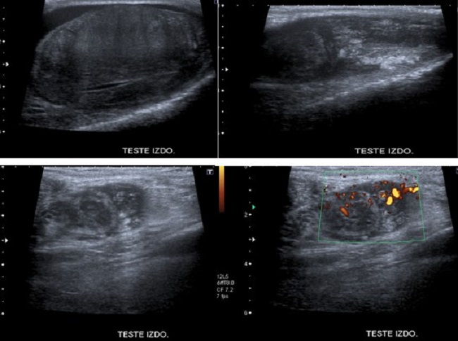 Teste izquierdo de unos 55x28 mm, con ecogenicidad muy heterog&eacute;nea, presentando zonas de mayor ecogenicidad, y otras de menor ecogenicidad, de forma difusa, sin identificar claramente lesiones nodulares. Peque&ntilde;o ap&eacute;ndice testicular. Marcado engrosamiento difuso de todo el epid&iacute;dimo, con alteraci&oacute;n de laecogenicidad, y vascularizaci&oacute;n incrementada. Abundante l&iacute;quido en cavidad escrotal.