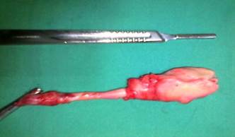 Caracter&iacute;sticas del ap&eacute;ndice cecal y la tumoraci&oacute;n en su tercio distal.