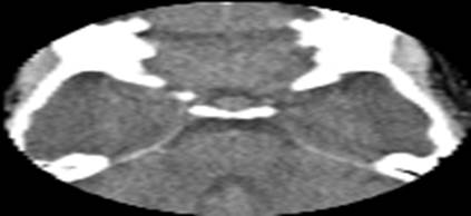 Tomograf&iacute;a axial computarizada de cr&aacute;neo simple.