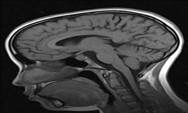 Imagen de resonancia magn&eacute;tica de la silla turca aumentada.