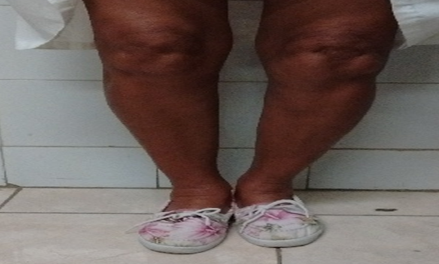 Imagen cl&iacute;nica de paciente con deformidad en varo de ambas rodillas, m&aacute;s marcada en la izquierda.